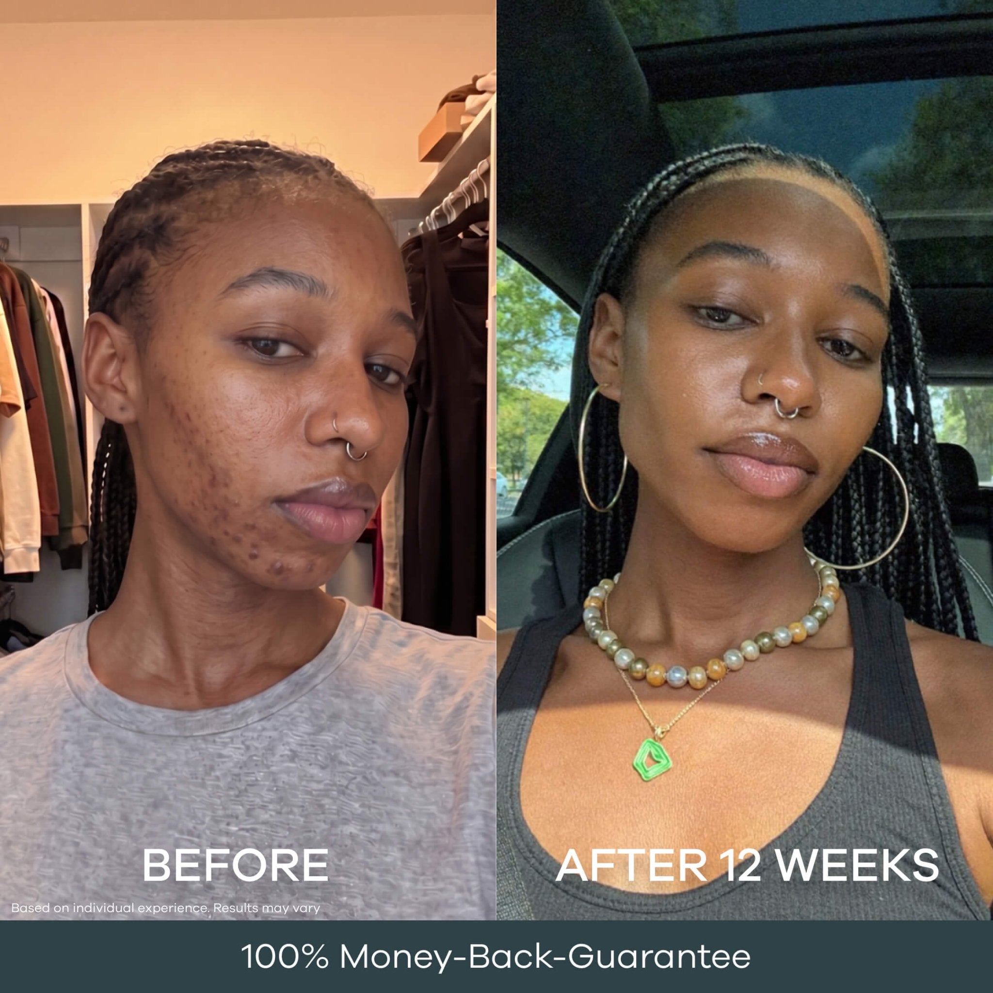 The Micro Infusion System™ Pigmentation For Melanin-Rich Skin